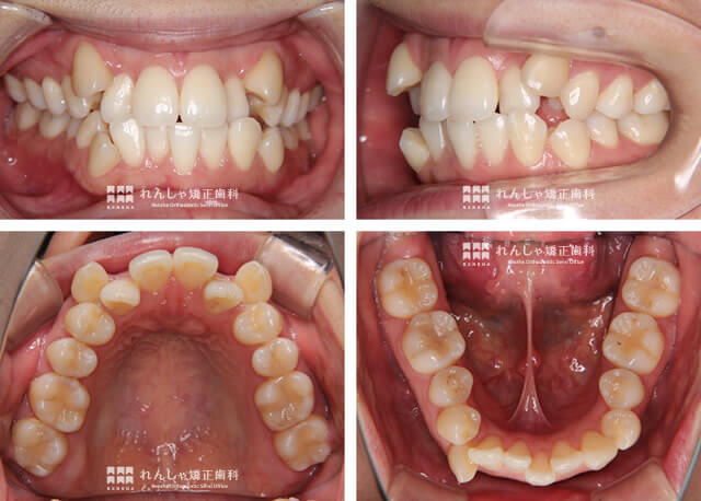 大人の矯正症例 れんしゃ矯正歯科