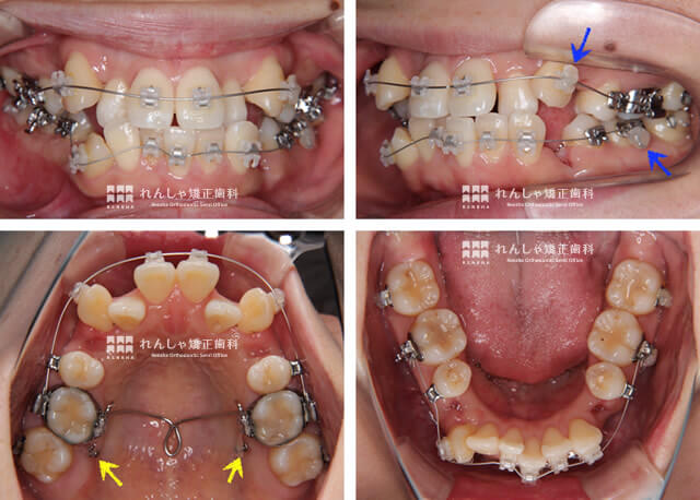 大人の矯正症例 れんしゃ矯正歯科