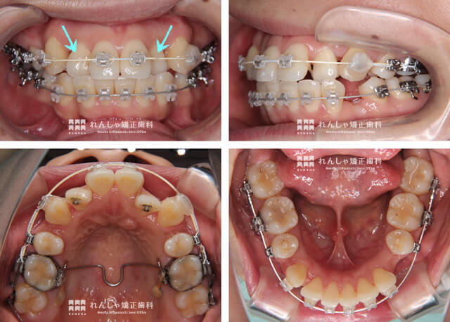 大人の矯正症例 れんしゃ矯正歯科